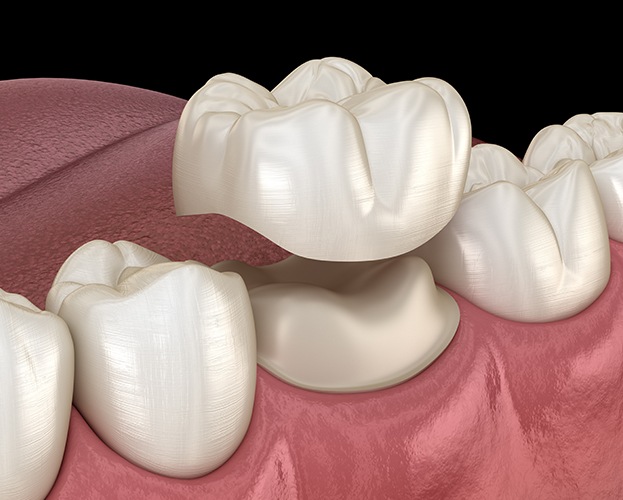 Crowns and Bridges on Implants and Natural Teeth - DrChang