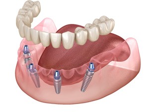 diagram of implant dentures in West Seneca