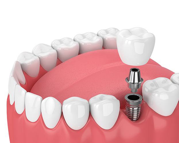 diagram of single tooth dental implant in West Seneca