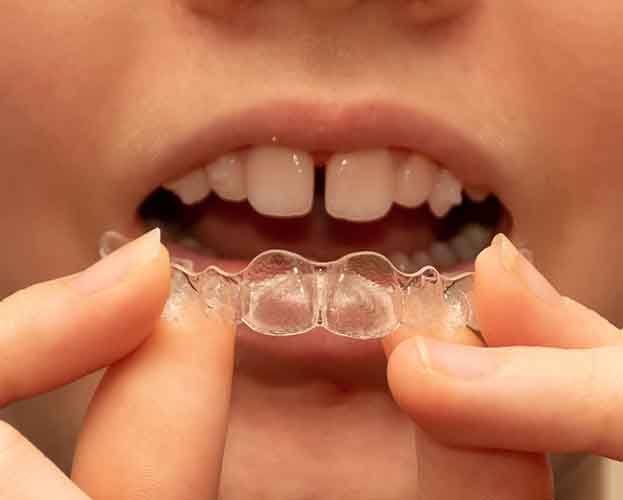 closeup of a woman’s mouth and putting in aligners