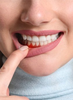 woman pointing to inflamed gums 