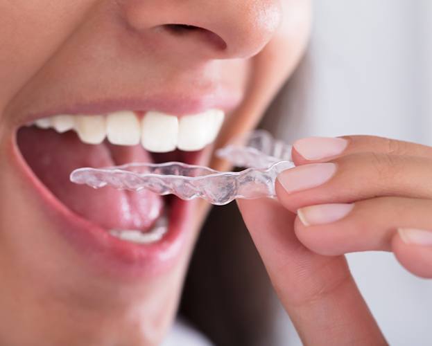 Patient placing an Invisalign clear braces tray